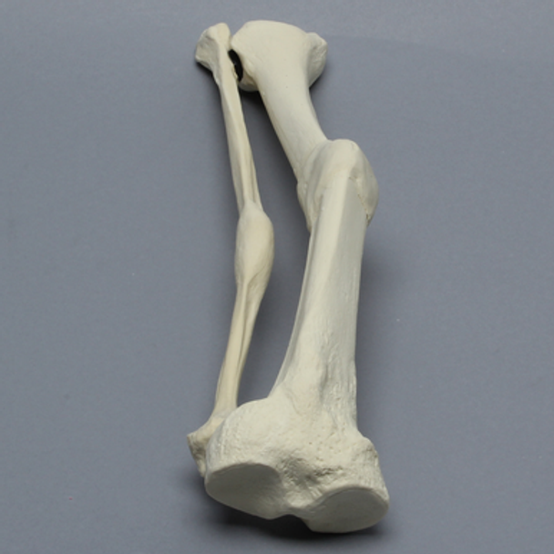 Tibia and Fibula with Malunions and Plane Defect