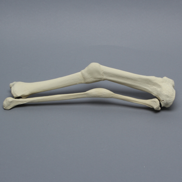 Tibia and Fibula with Malunions and Plane Defect