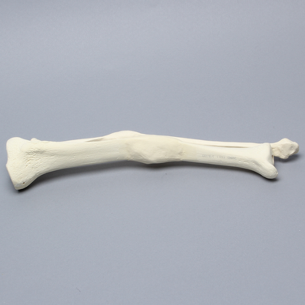 Tibia and Fibula with Malunions and 10º Varus Defect
