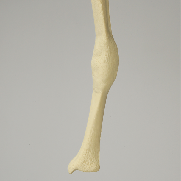Tibia with Midshaft Malunion and 10º Varus Defect