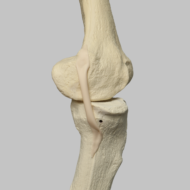 Knee with Three Stretch Tube Ligaments, Full Length, Arthritic
