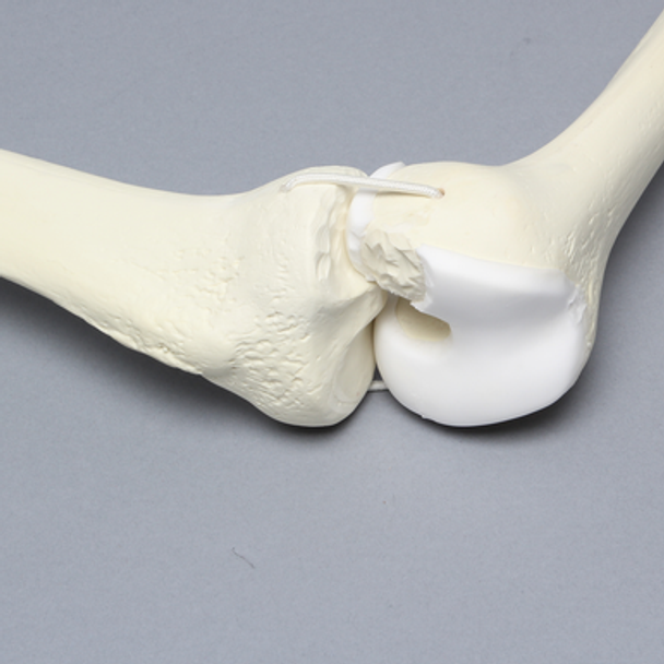 Knee with Erosion and Three Stretch Cord Ligaments, Full Length