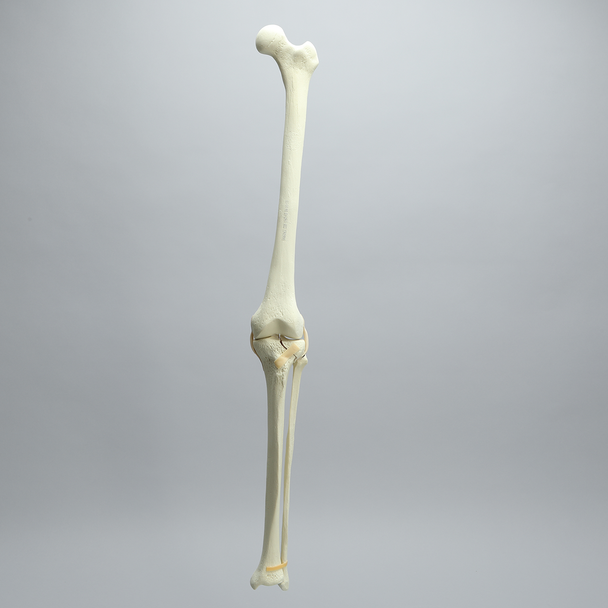 Knee with Unicondylar Fracture and Collateral Ligaments, Full Length
