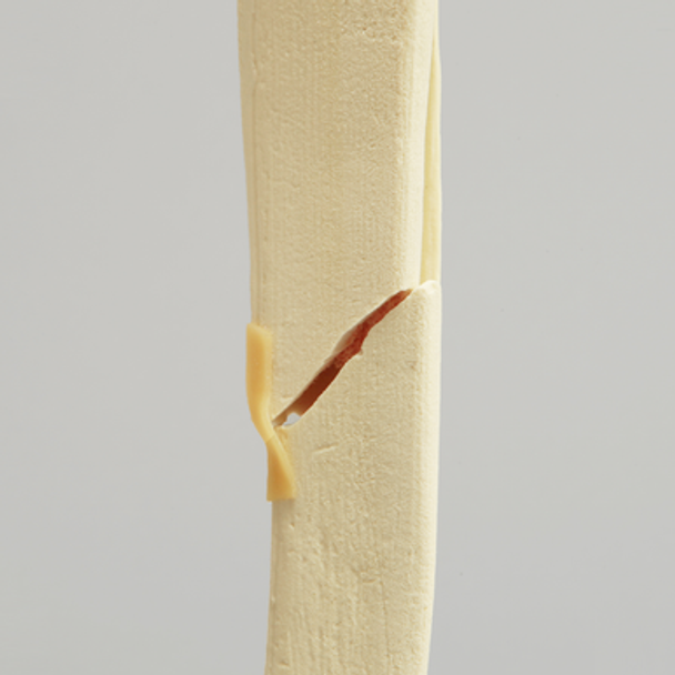 Knee with Bicondylar and Oblique Fractures of the Tibia, Full Length