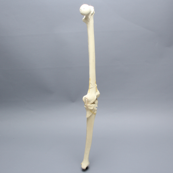 Knee with Femoral Butterfly and Tibial Plateau Fracture, Full Length