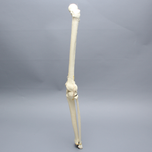Knee with Femoral Butterfly and Tibial Plateau Fracture, Full Length