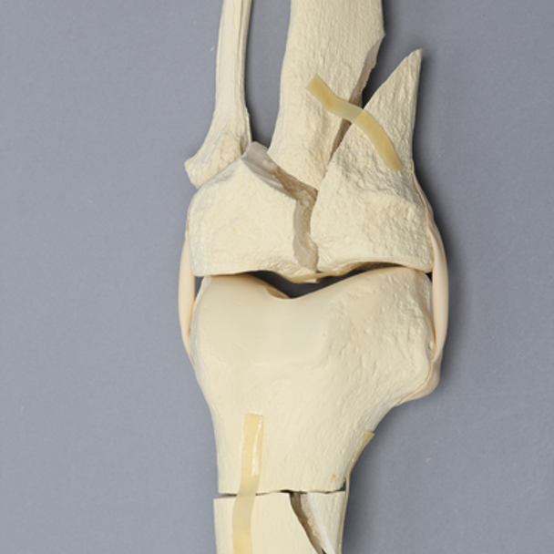 Knee with Femoral Butterfly and Tibial Plateau Fracture, Full Length