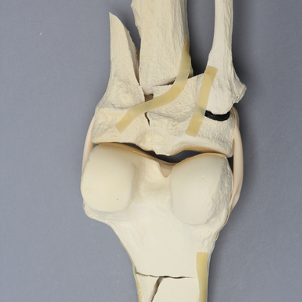 Knee with Femoral Butterfly and Tibial Plateau Fracture, Full Length