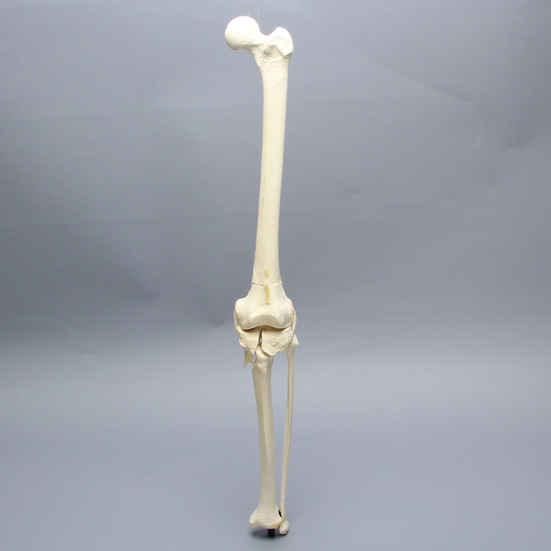 Knee with Femoral Butterfly and Tibial Plateau Fracture, Full Length