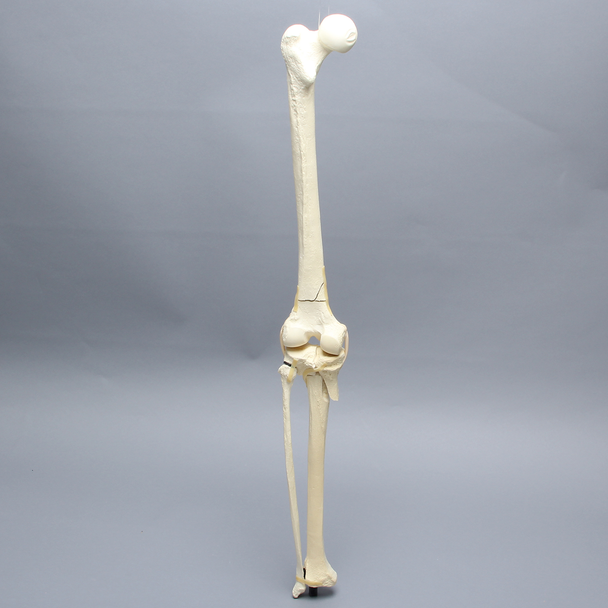 Knee with Femoral Butterfly and Tibial Plateau Fracture, Full Length