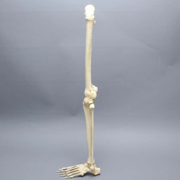 Leg with Plateau Fracture, Full Length