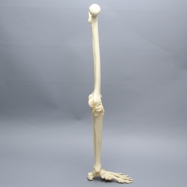 Leg with Plateau Fracture, Full Length