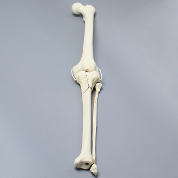Knee with Comminuted Fracture, Full Length