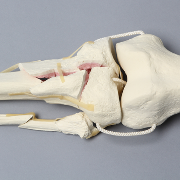 Knee with Comminuted Fracture, Full Length
