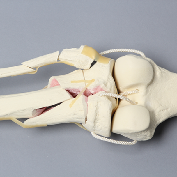 Knee with Comminuted Fracture, Full Length
