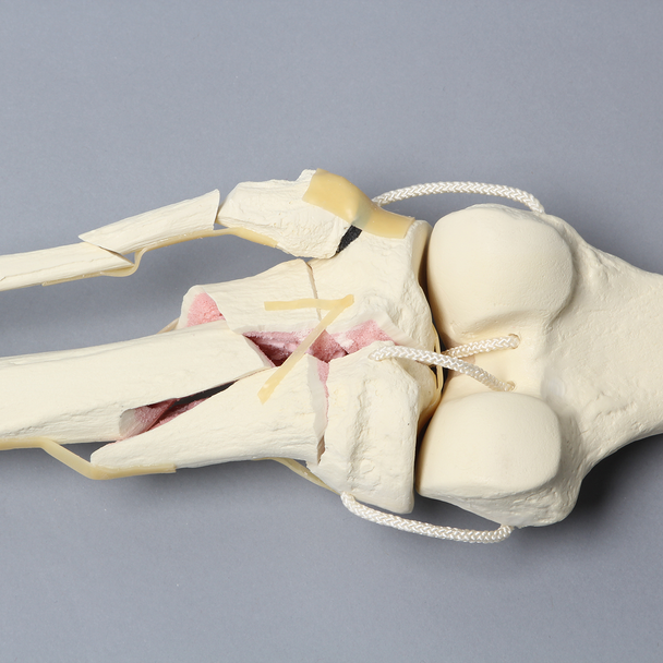 Knee with Comminuted Fracture, Full Length