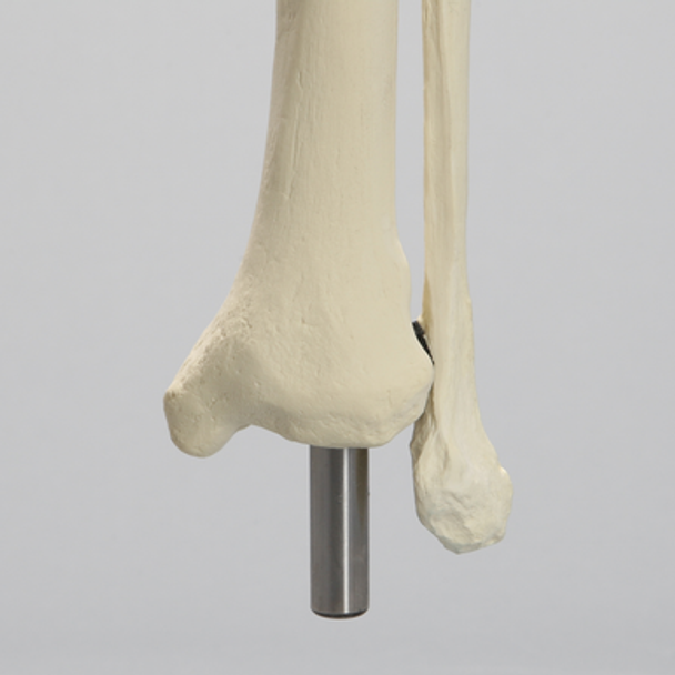 Knee Replacement with Tibia and Fibula