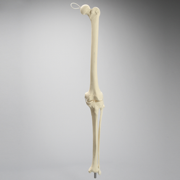 Knee Replacement with Tibia and Fibula