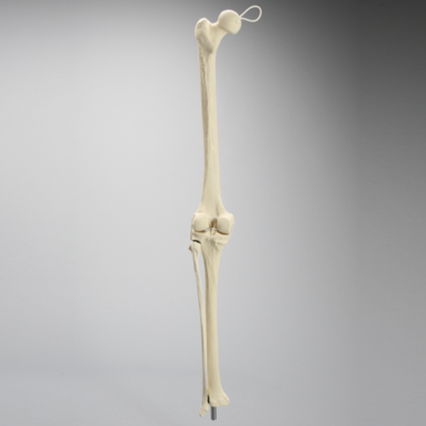 Knee Replacement with Tibia and Fibula