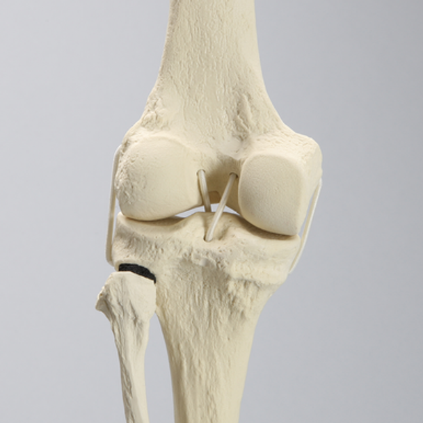 Knee Replacement with Tibia and Fibula