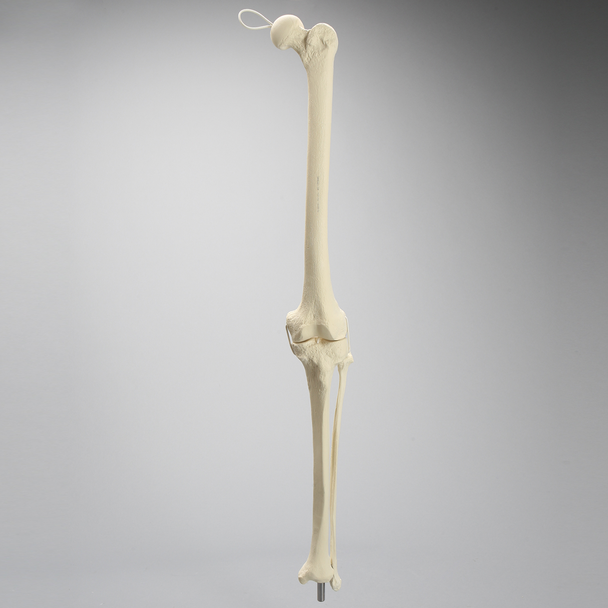 Knee Replacement with Tibia and Fibula