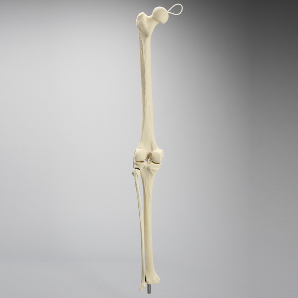 Knee Replacement with Tibia and Fibula