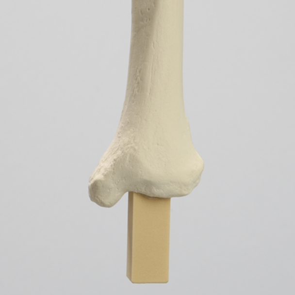 Knee Replacement for Hip Assembly #1301-160