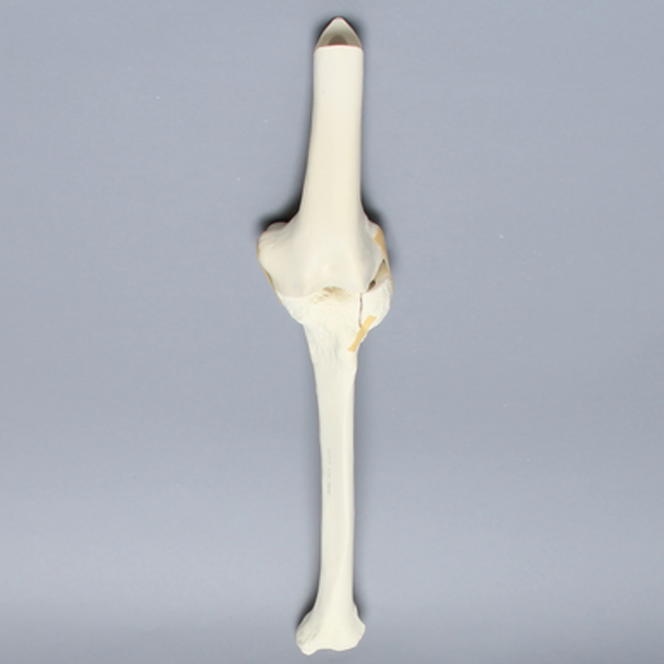 Knee with Plateau Fracture
