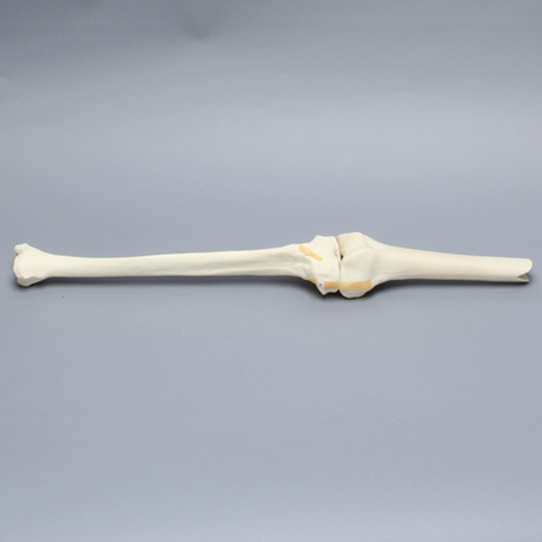Knee with Plateau Fracture