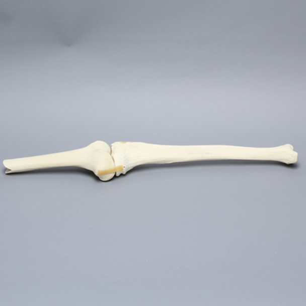 Knee with Plateau Fracture