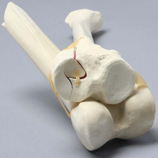 Knee with Plateau Fracture