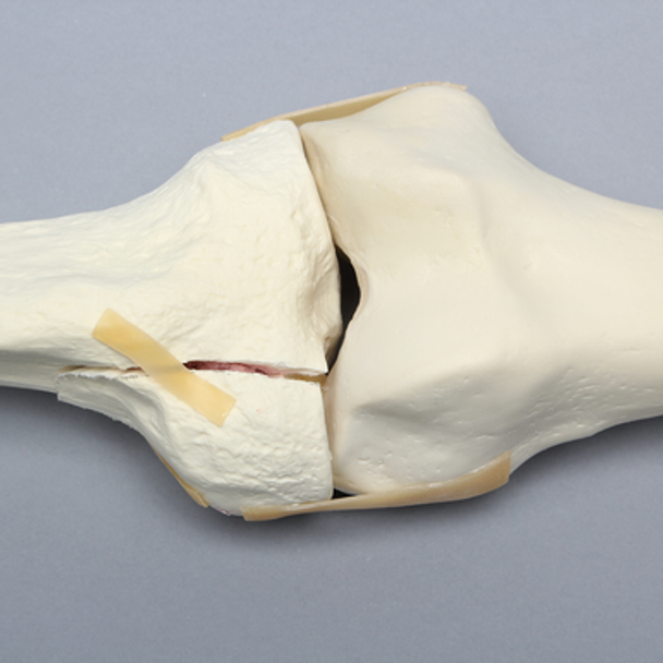 Knee with Plateau Fracture
