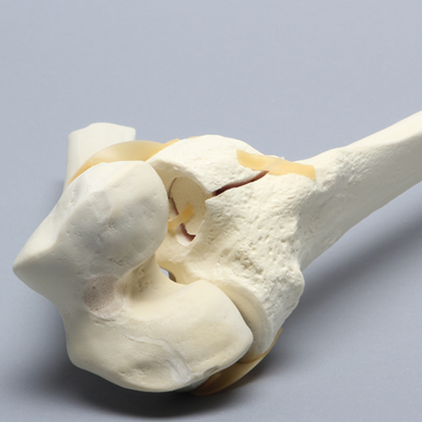 Knee with Plateau Fracture
