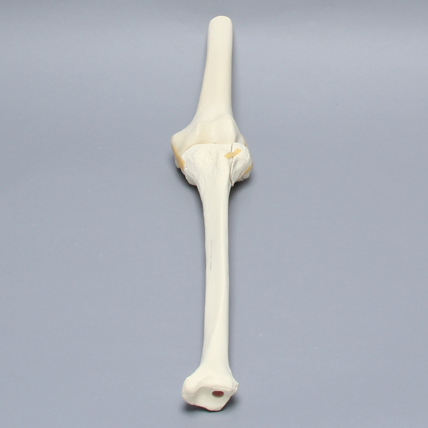 Knee with Plateau Fracture