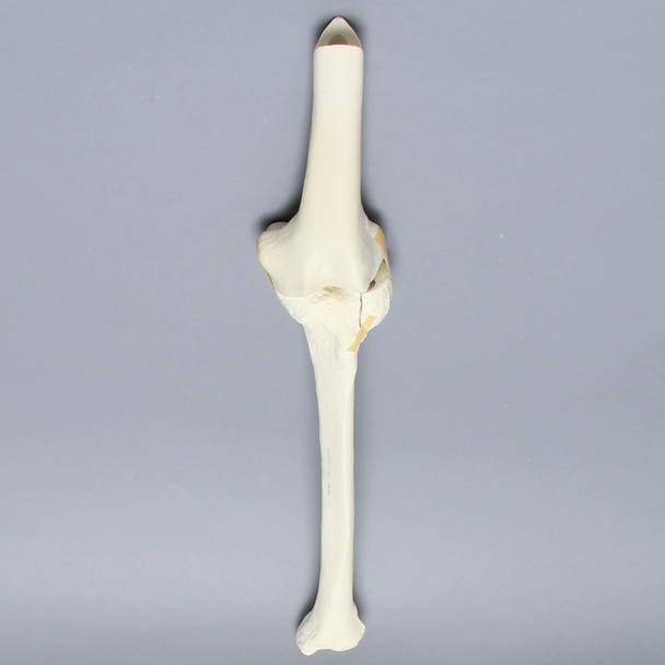 Knee with Plateau Fracture