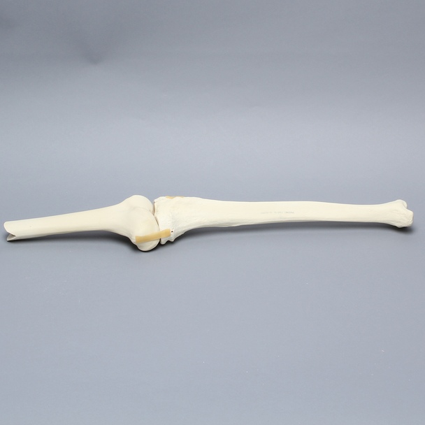 Knee with Plateau Fracture