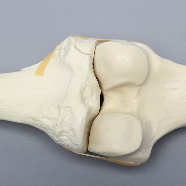 Knee with Plateau Fracture