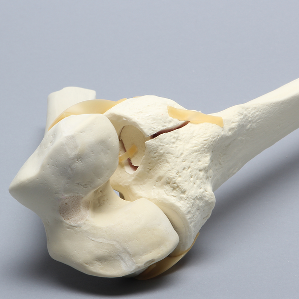 Knee with Plateau Fracture