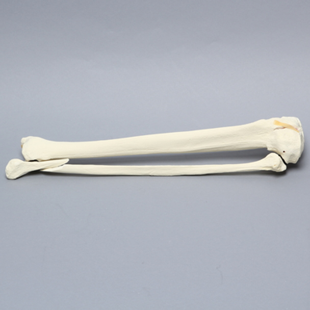 Tibia and Fibula with Condylar, Malleolar, and Oblique Fractures