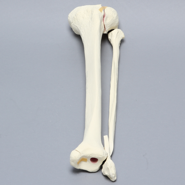 Tibia and Fibula with Condylar, Malleolar, and Oblique Fractures