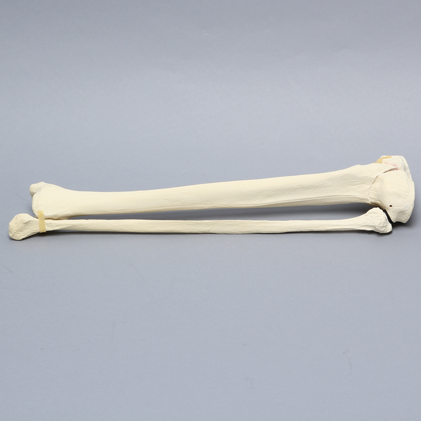 Tibia and Fibula with Bicondylar "Y" Fracture