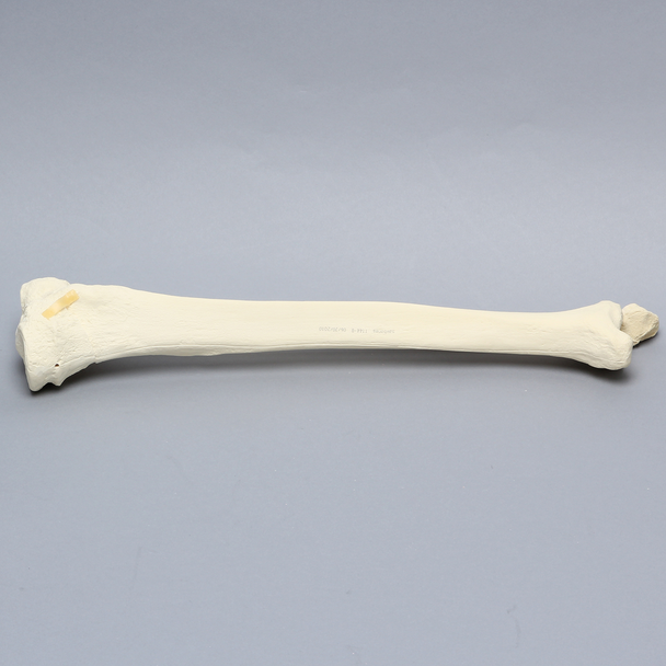 Tibia and Fibula with Bicondylar "Y" Fracture