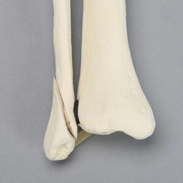 Tibia and Fibula with Oblique Fibular Fracture