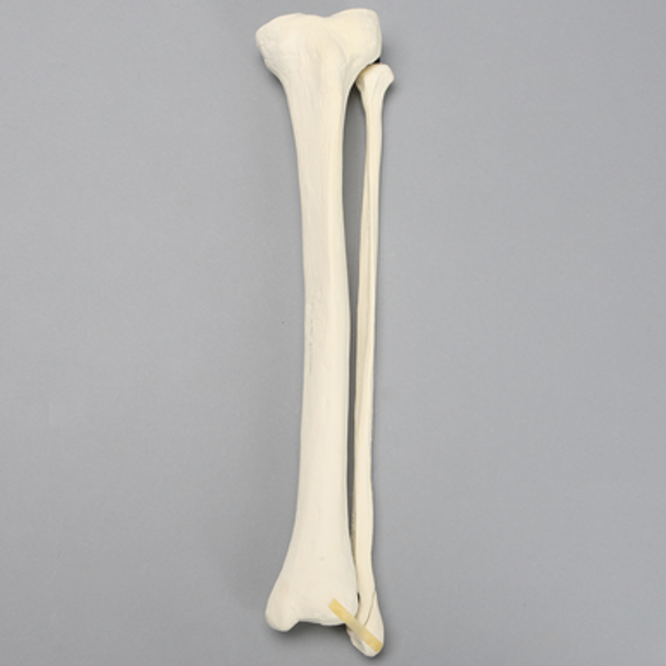 Tibia and Fibula with Oblique Fibular Fracture