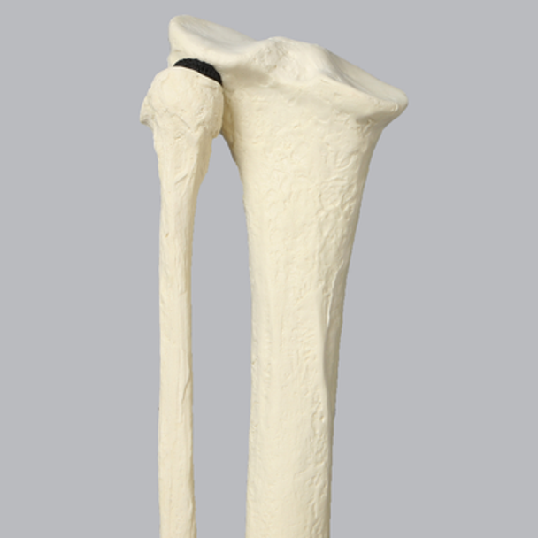 Tibia and Fibula with Blount's Disease