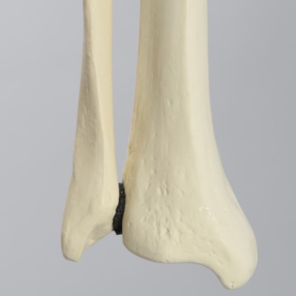 Tibia and Fibula with Fibular Rotation