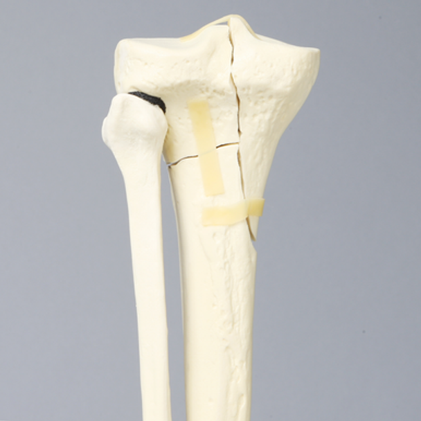 Tibia and Fibula with Plateau and Oblique Fractures