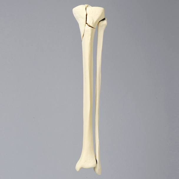 Tibia and Fibula with Plateau and Oblique Fractures