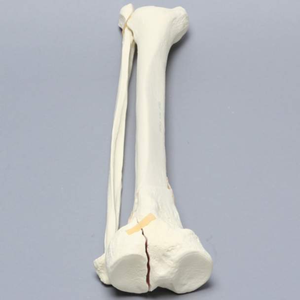 Tibia and Fibula with Type Six Tibial Plateau Fracture