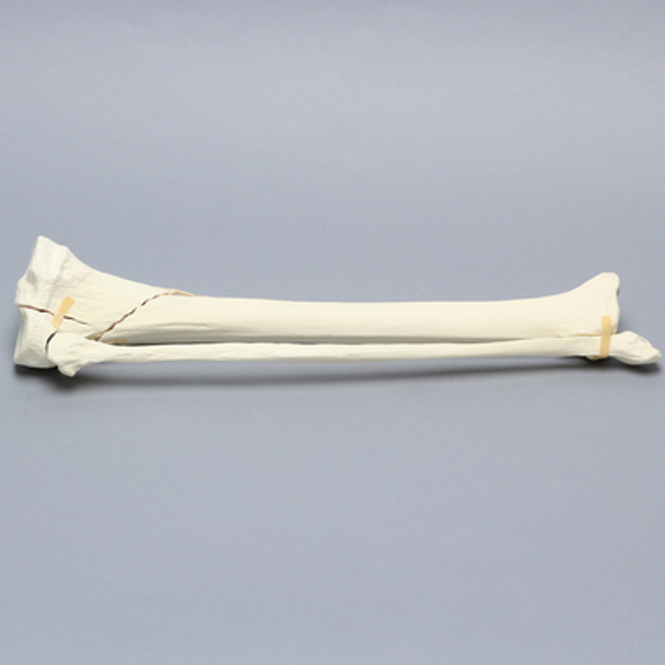 Tibia and Fibula with Type Six Tibial Plateau Fracture